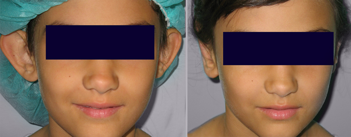 Correction of the ears